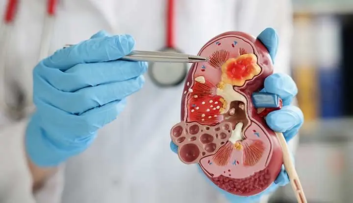 Kidney Stone / Gall Stone
